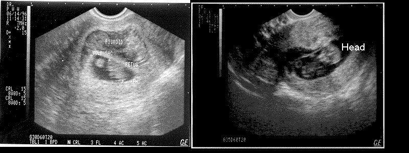9 and 11 week sonograms